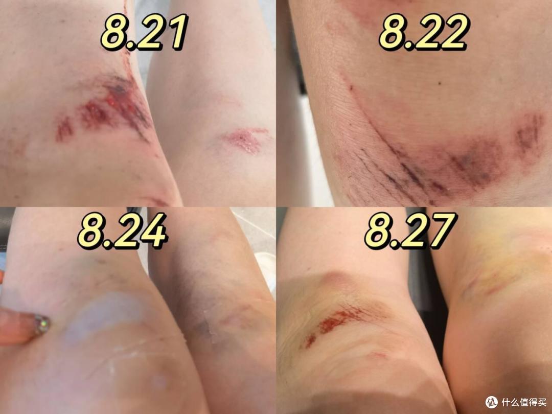 擦伤膝盖胳膊腿，怎么护理才能不留疤？摔伤后护理全过程实录，跟我这样做真的不留疤！！