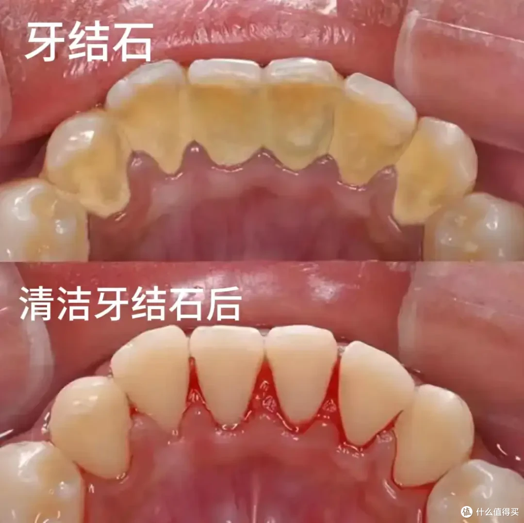 你需要一台什么样的冲牙器?这篇选购攻略可以帮到你