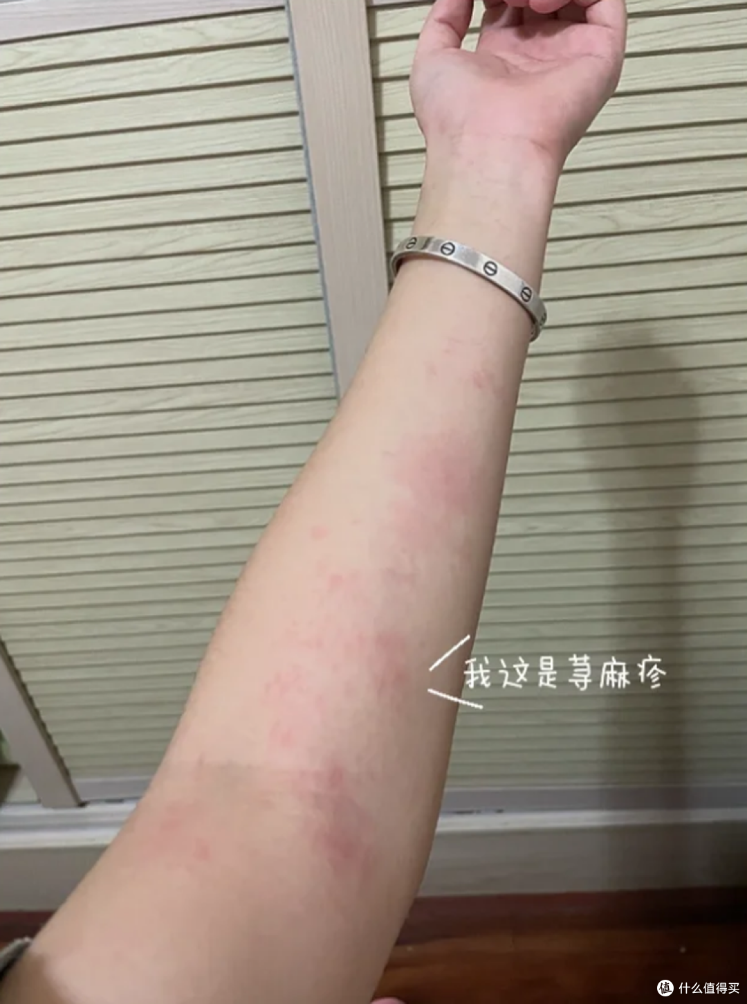 换季皮肤过敏爆发荨麻疹，两天缓解办法