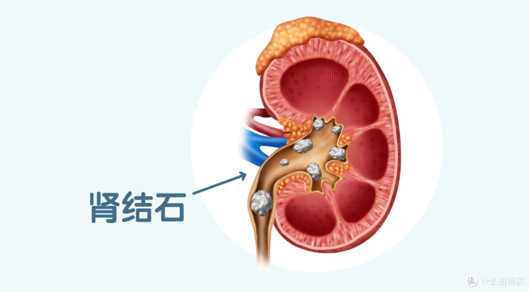 震惊!为什么越来越多的人得肾结石?赶紧听听劝告吧,这2个习惯千万要改掉!