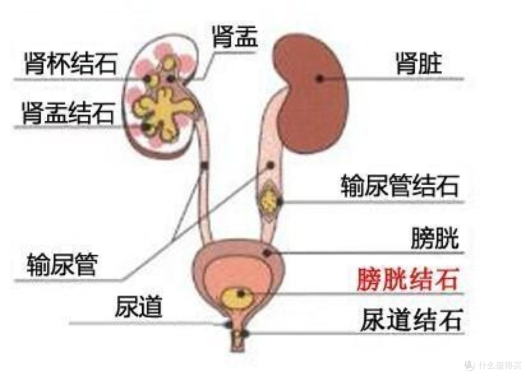 震惊!为什么越来越多的人得肾结石?赶紧听听劝告吧,这2个习惯千万要改掉!