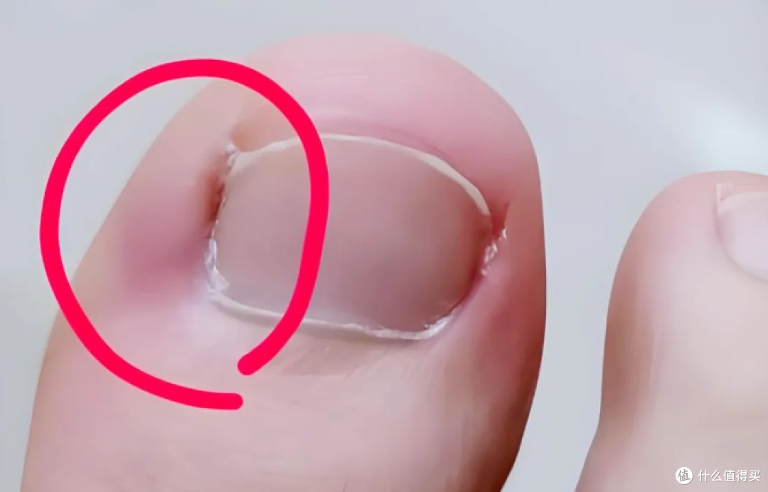 脚趾甲老往肉里钻,一碰还疼?这几招可预防!