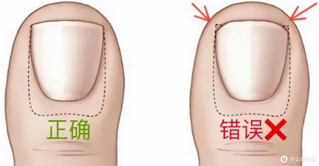 脚趾甲老往肉里钻,一碰还疼?这几招可预防!