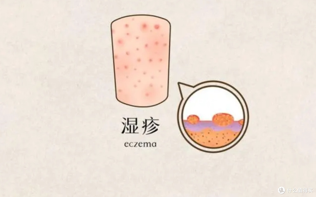 成人湿疹不用怕!醋酸地塞米松乳膏,让你告别烦恼?