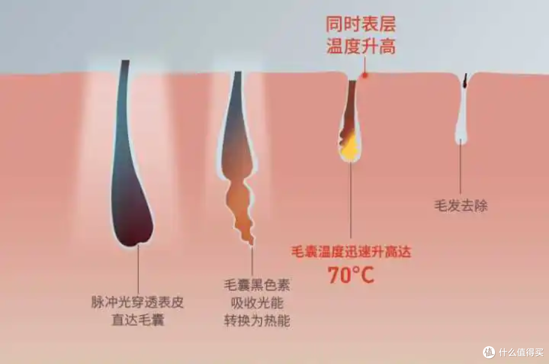 脱毛仪真的有用吗?脱毛仪能永远脱毛吗?