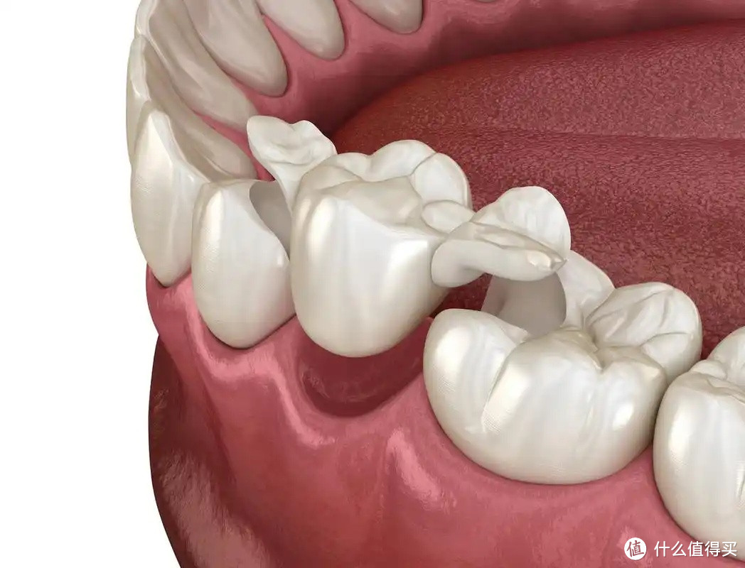 补不补牙？超详细的补牙指南来咯，建议收藏！