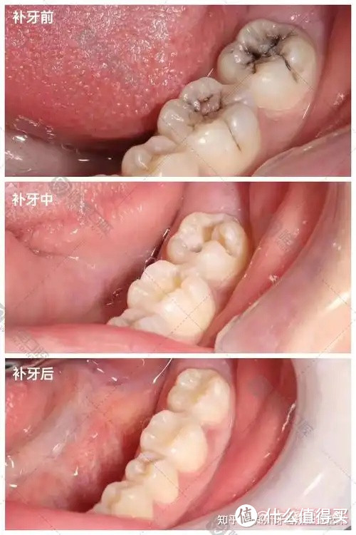 补不补牙？超详细的补牙指南来咯，建议收藏！