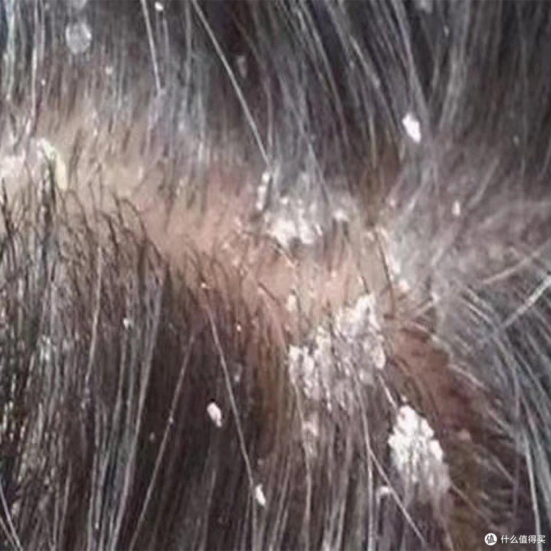 用什么洗头发改善毛囊炎?？好用的止痒去屑洗发水介绍