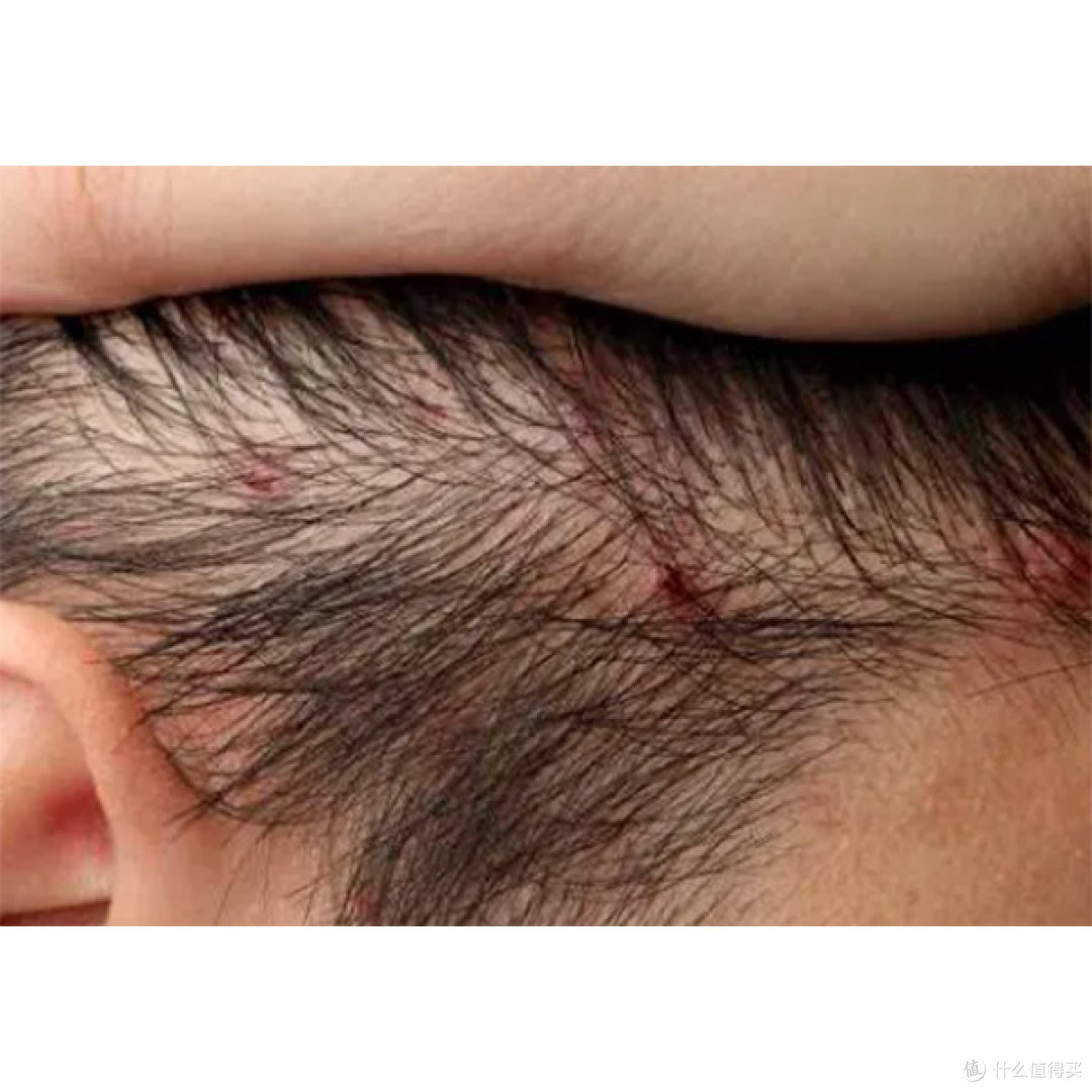 什么洗发水去头皮屑效果好女士用?？能去屑止痒的洗发水排行榜