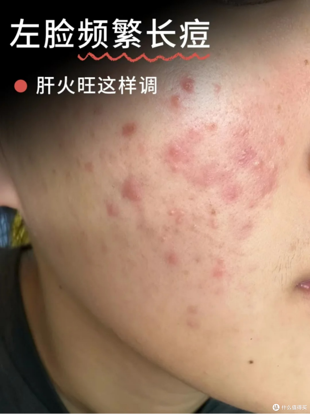 左脸颊频繁长痘，多是肝火上行！肝火旺这样调！