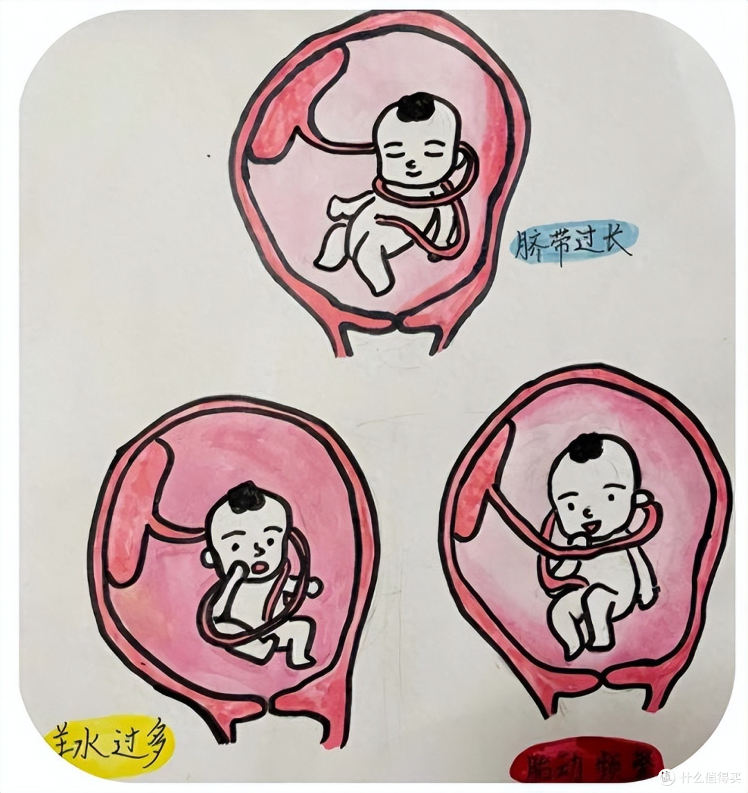 胎儿脐带绕颈6圈遇险情,多亏妈妈机智,孕期这件事千万别偷懒!