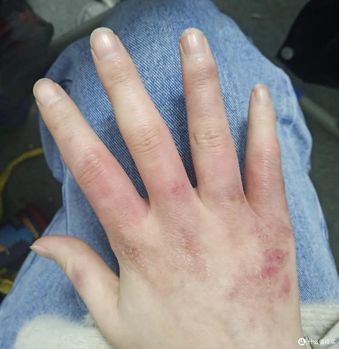 难怪红霉素软膏卖得那么火，这5个妙用解决大烦恼，看完涨知识了