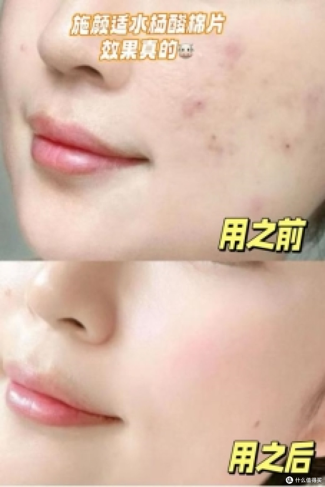 Stridex施颜适水杨酸棉片:油痘肌的救星