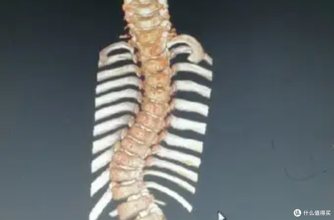 脊柱侧弯：健康隐患不容忽视，北京年轮中医骨科医院助力挺拔身姿