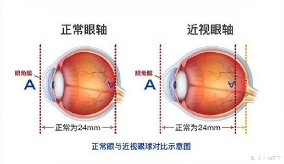 眼轴检查:近视防控的“隐形指标”,三个方法教你保护视力
