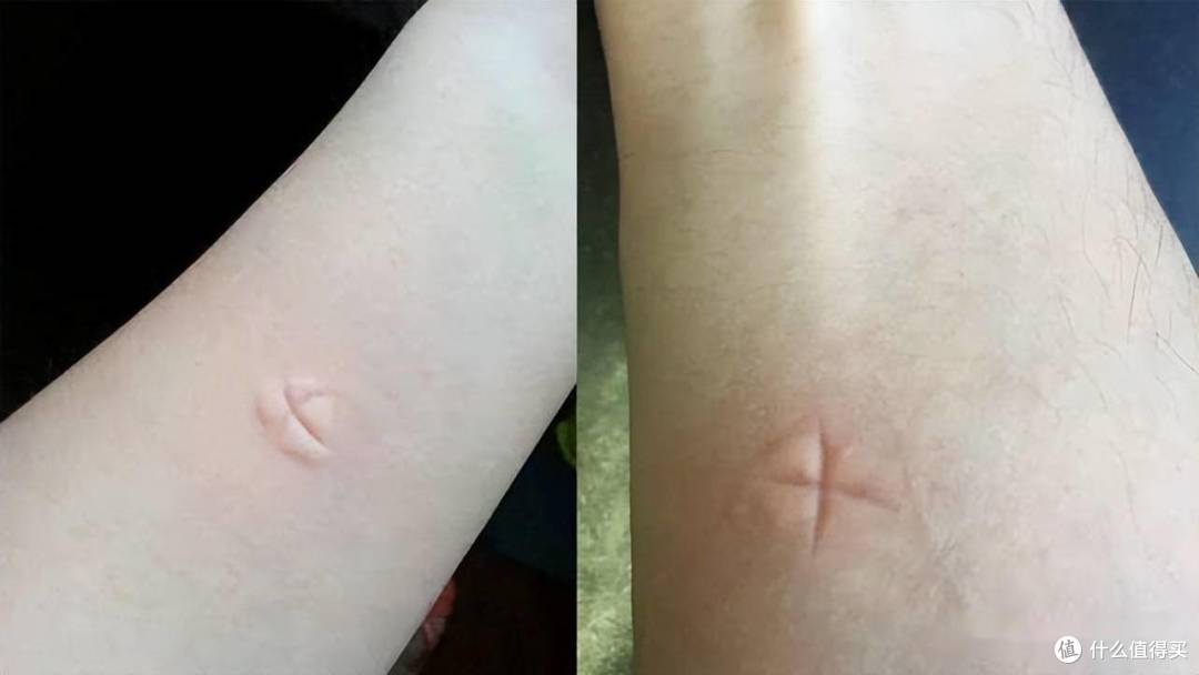 被蚊虫叮咬后又红又痒?教你几个妙招,快速消肿止痒!