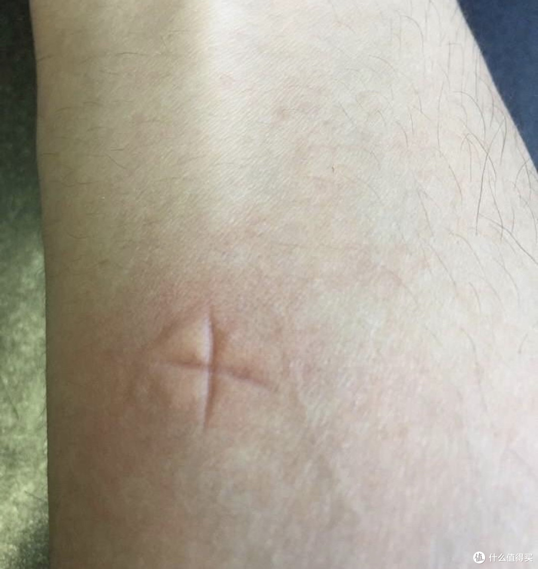 被蚊虫叮咬后又红又痒?教你几个妙招,快速消肿止痒!