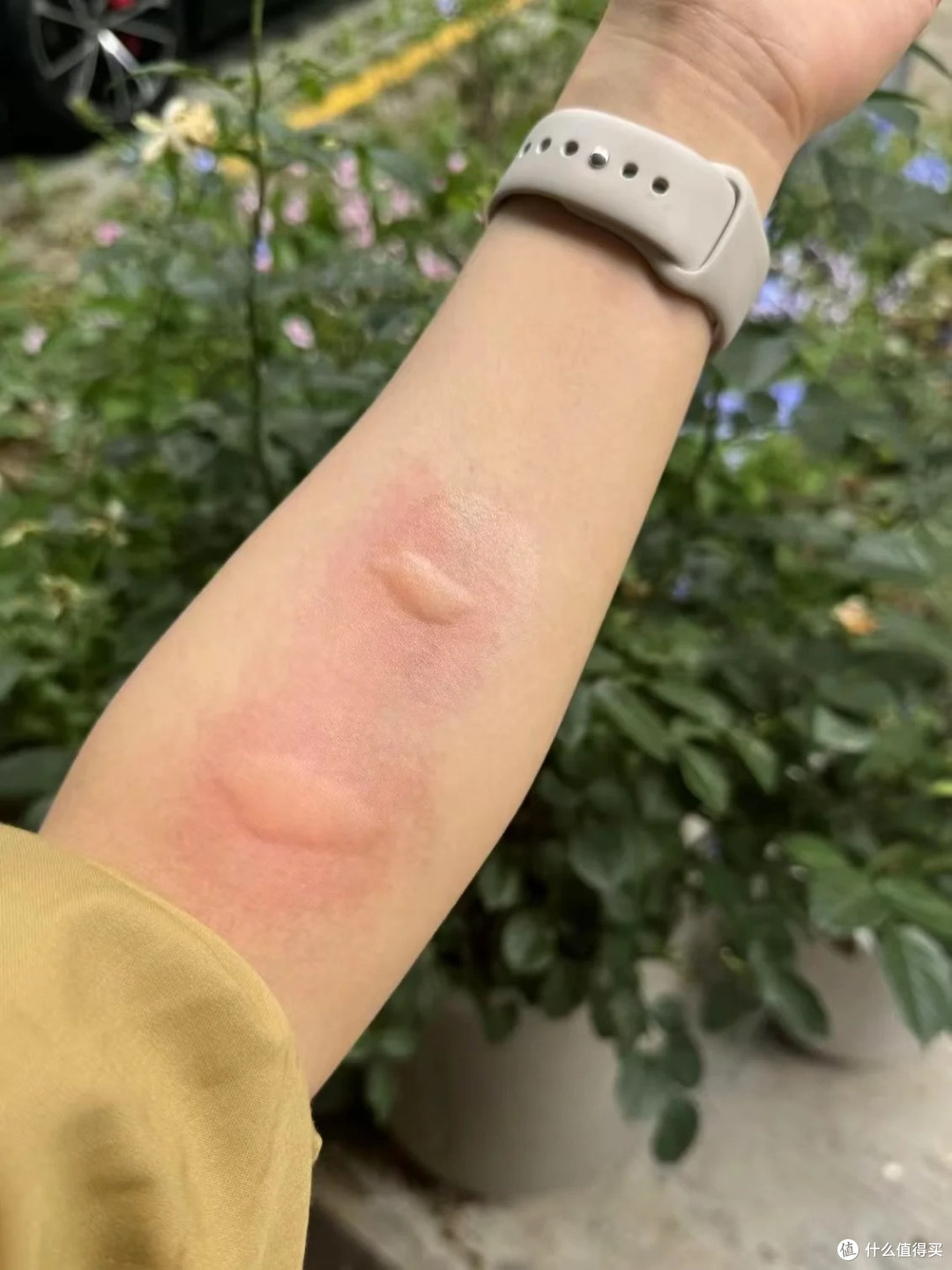 被蚊虫叮咬后又红又痒?教你几个妙招,快速消肿止痒!