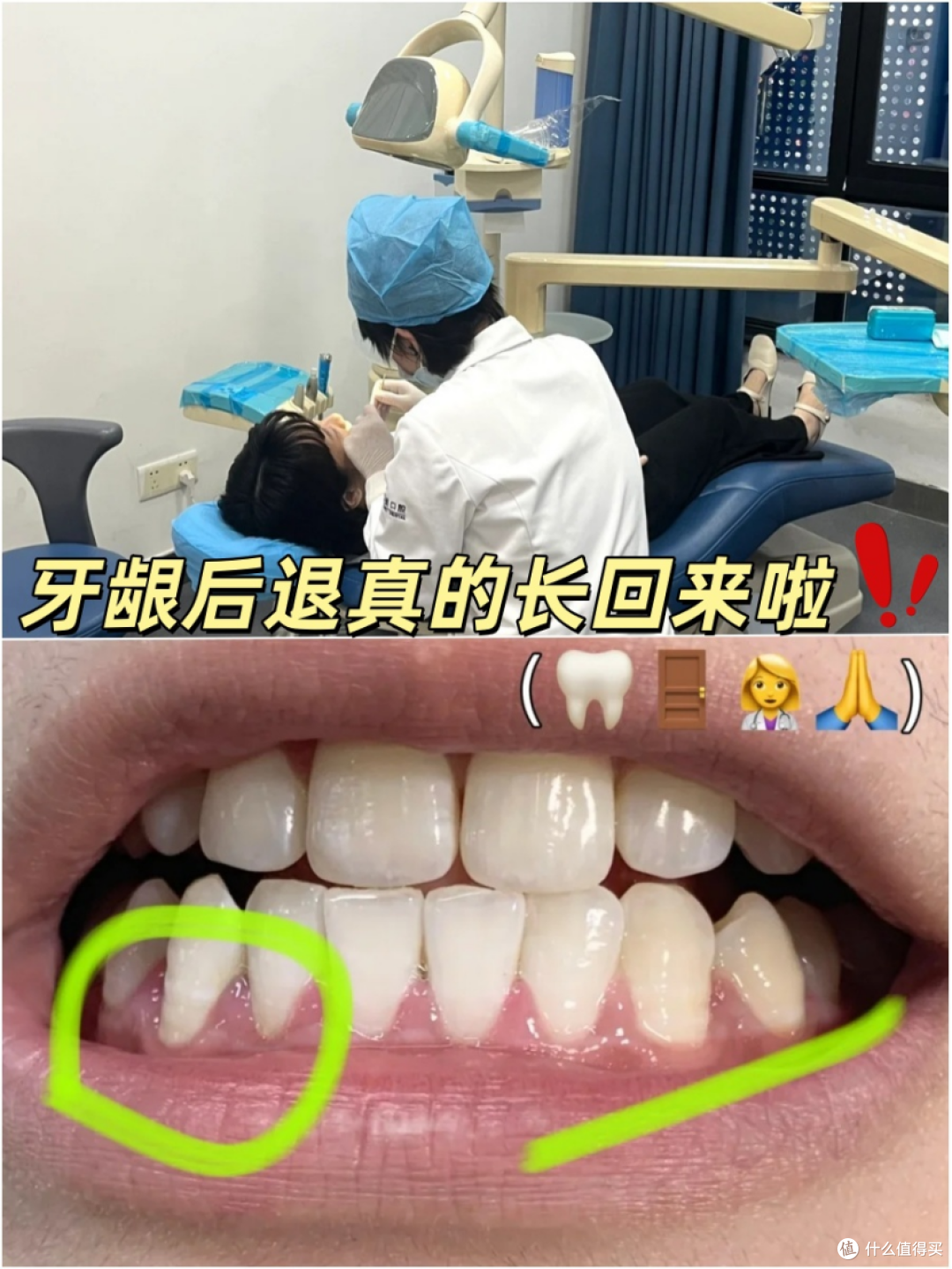 牙龈萎缩不但能好,而且很容易好!