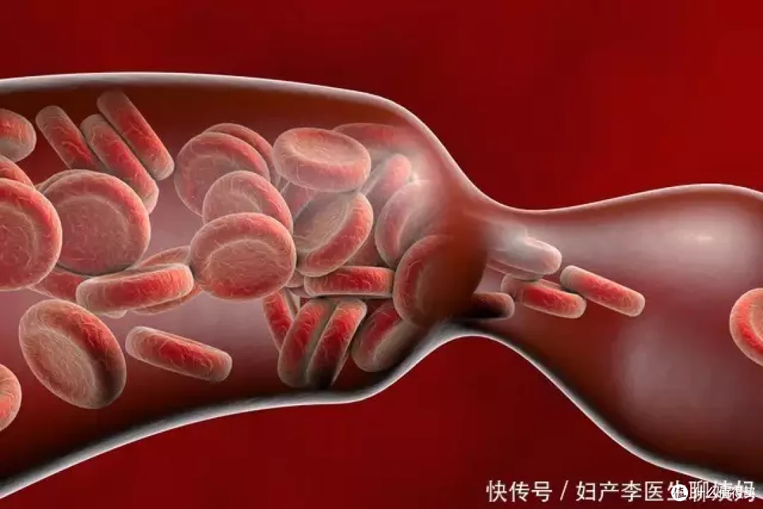 “血栓大户”被揪出！提醒：劝你少吃 3 种食物，越吃血管越堵