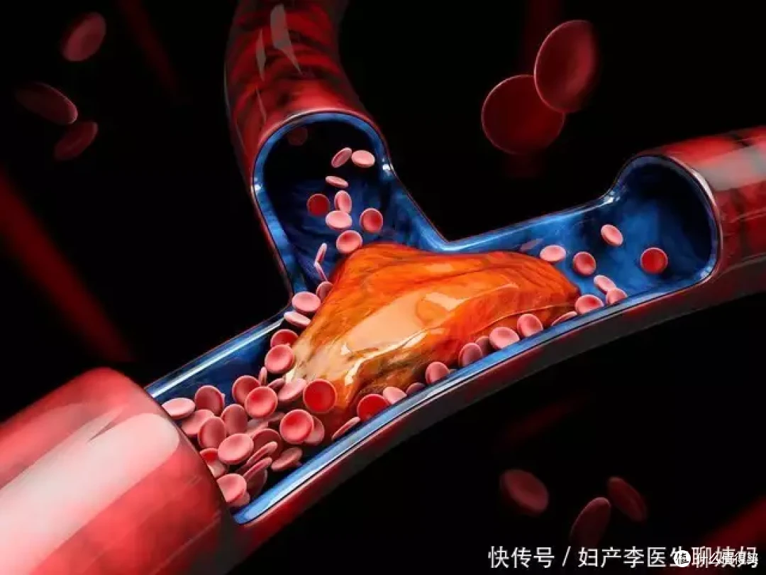 “血栓大户”被揪出！提醒：劝你少吃 3 种食物，越吃血管越堵