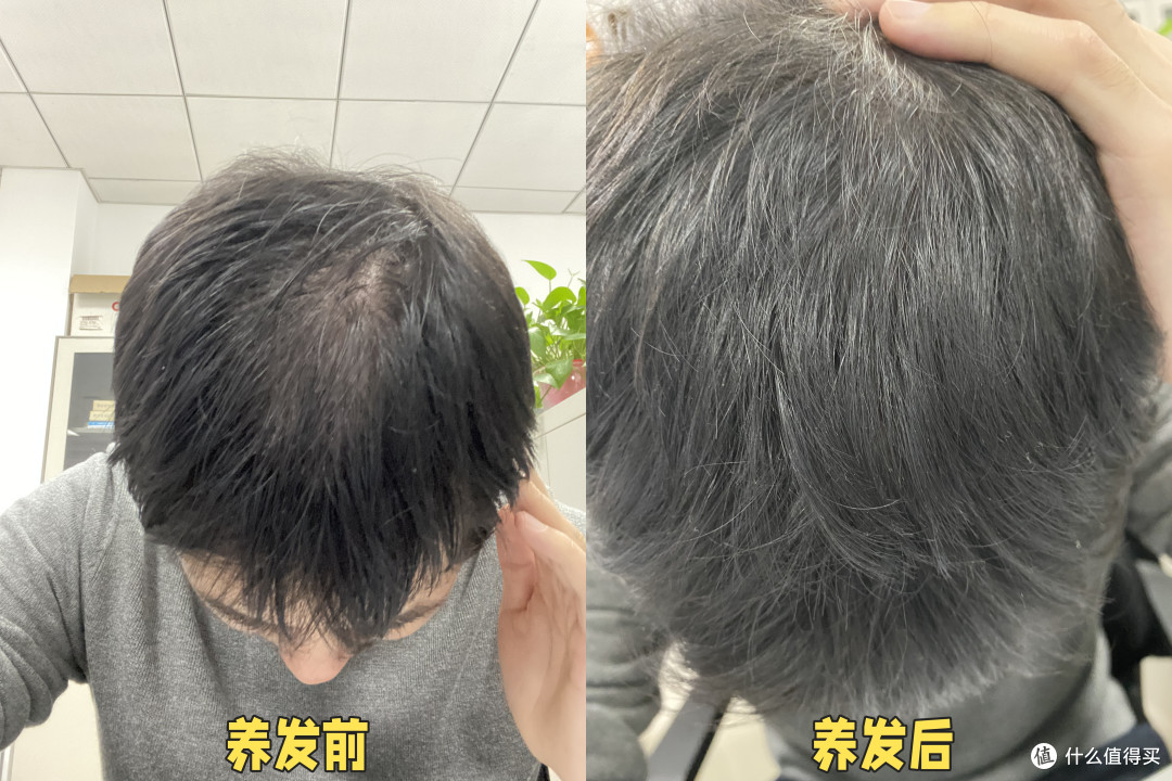 在升职和生财之间，我选择了生发。吐血整理的防脱攻略请收下！