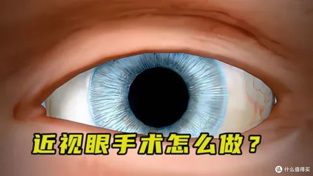 视力模糊的痛谁懂？定制角膜轮廓治疗为你排忧解难