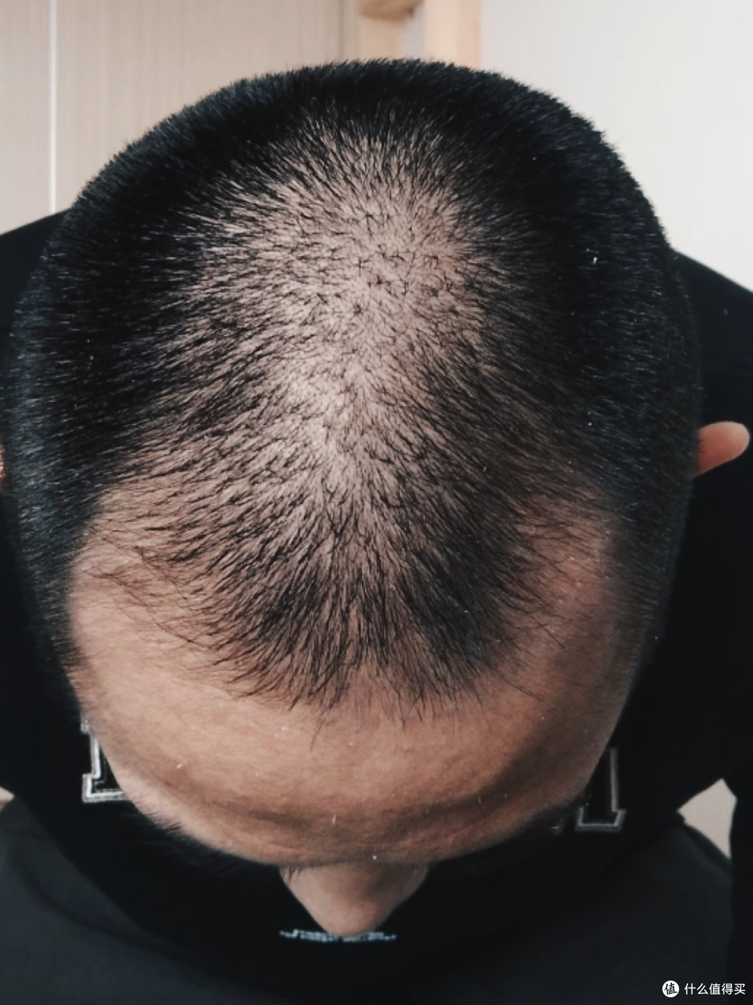 应对脂溢性脱发：一位普通人的实践心得与经验分享