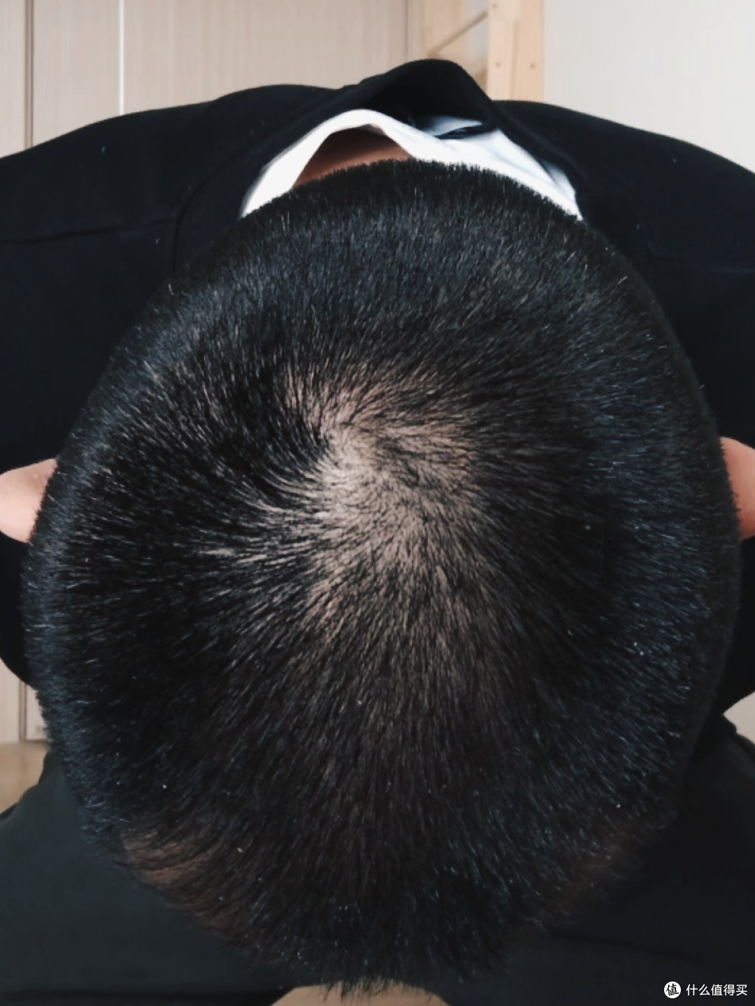 应对脂溢性脱发：一位普通人的实践心得与经验分享
