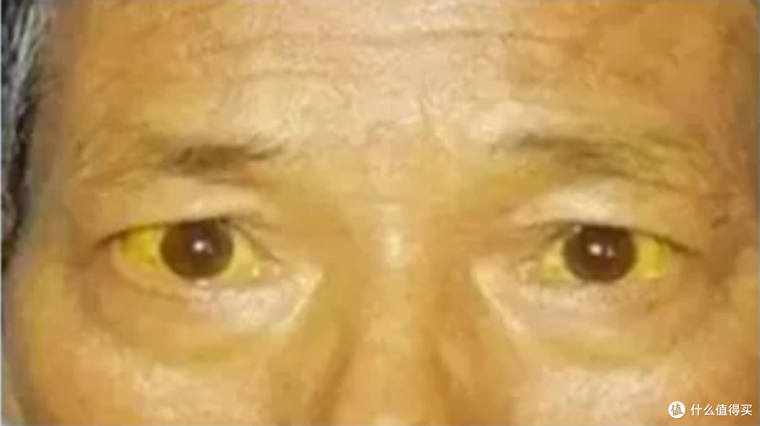 第一次内调,脂肪肝像是进入天堂了!