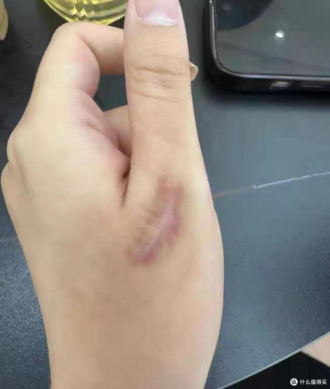 哪种疤痕贴好用？疤痕贴怎么选？