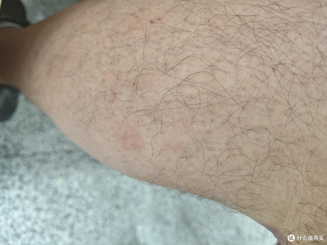 我是怎么通过养生的方法控制住我的荨麻疹