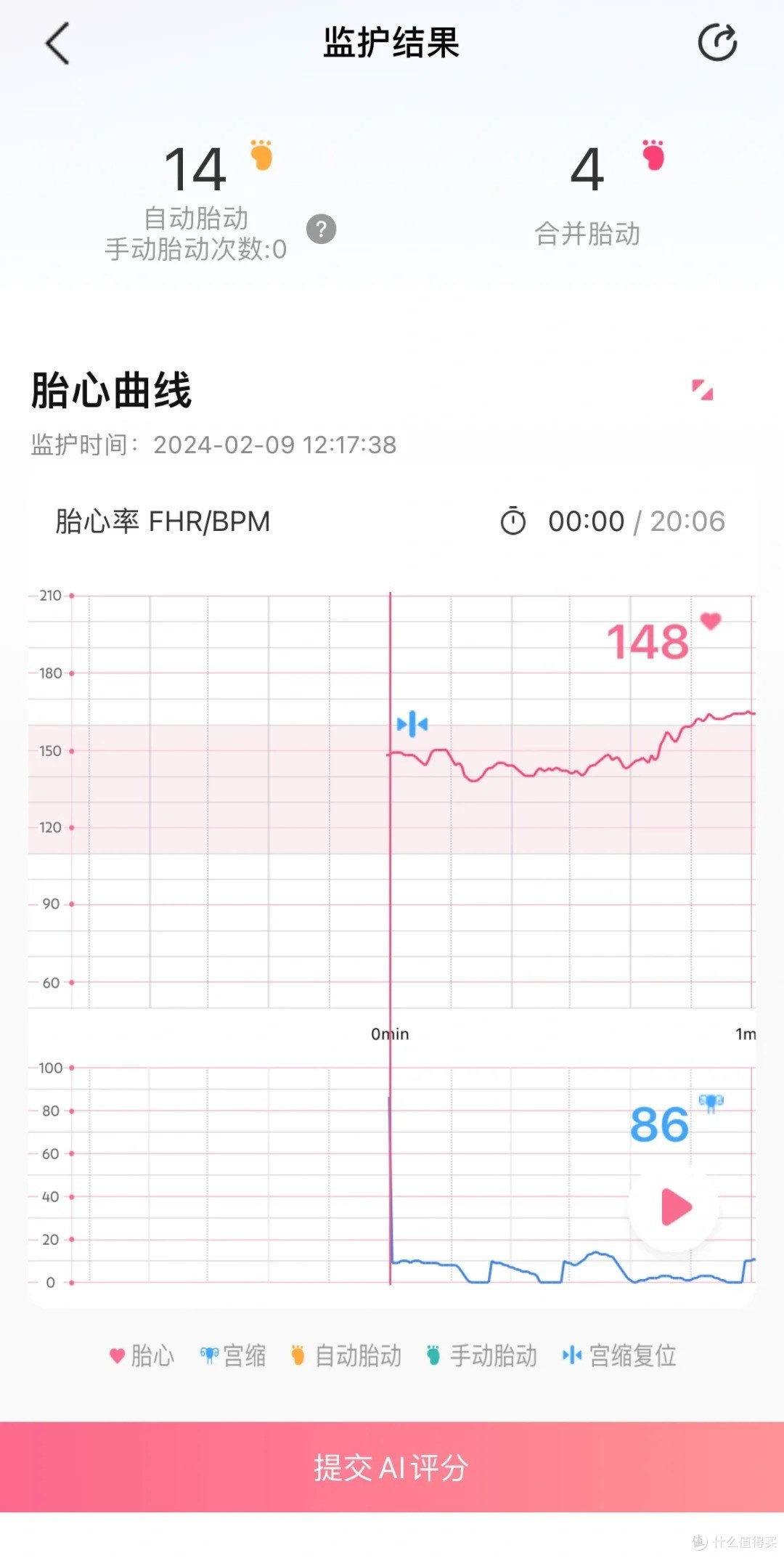 即使宝宝脐带绕颈两周 ,我依然不玻璃心