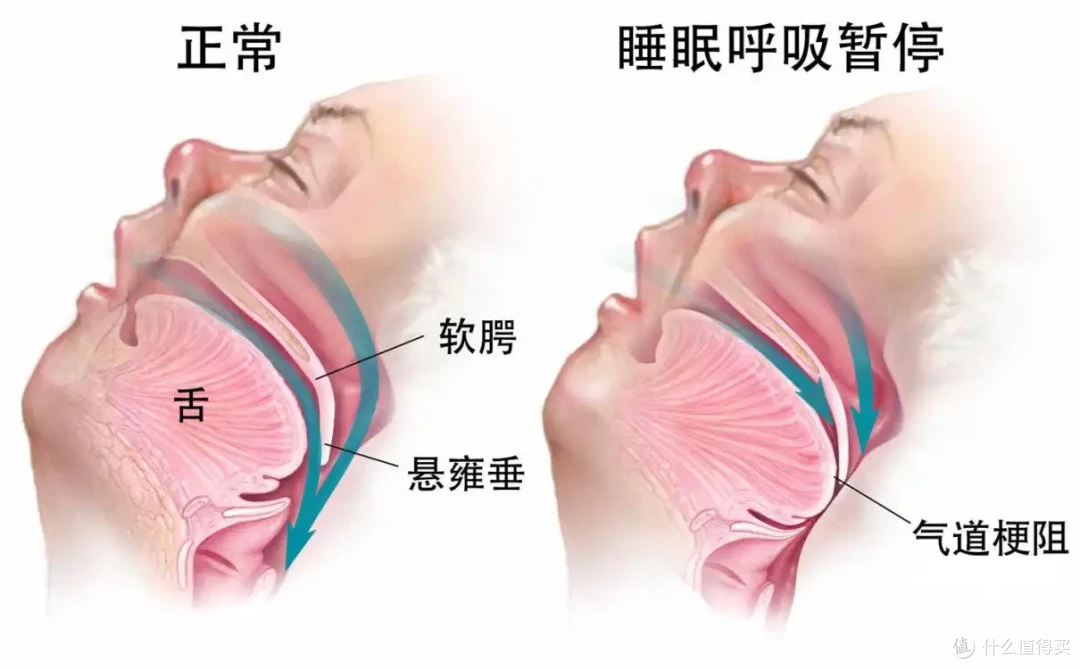 打呼噜有救了!瑞迈特E5家用呼吸机让深度睡眠不再是奢望!