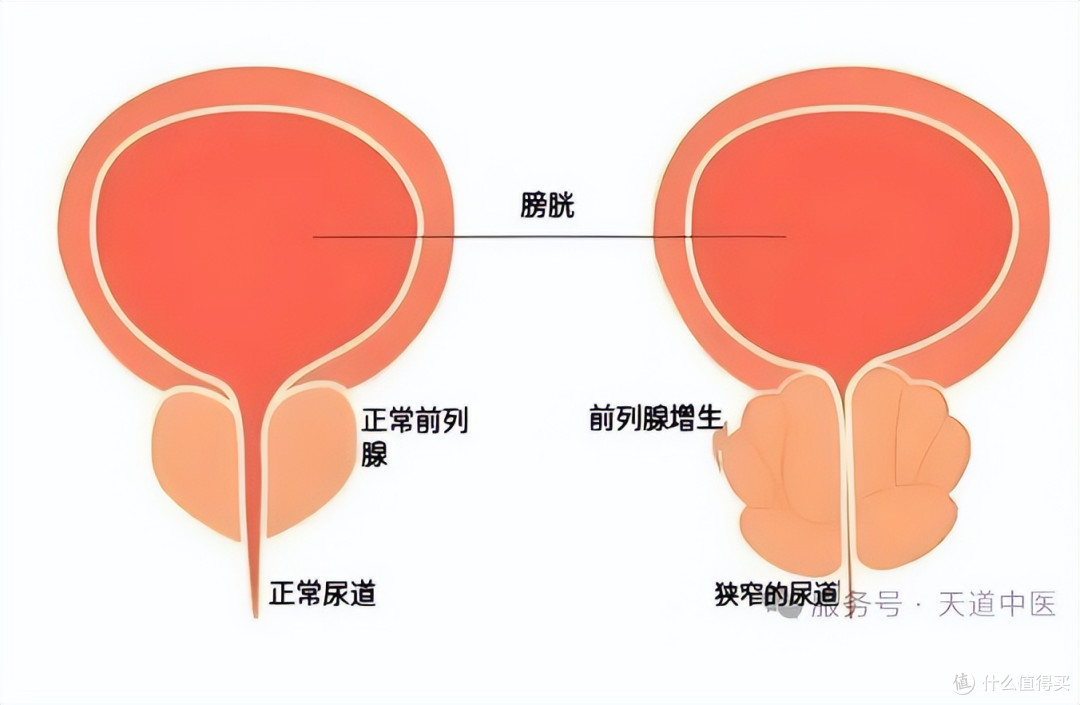 前列腺肥大伴钙化:症状、原因与汽熥疗法的创新外治原理。