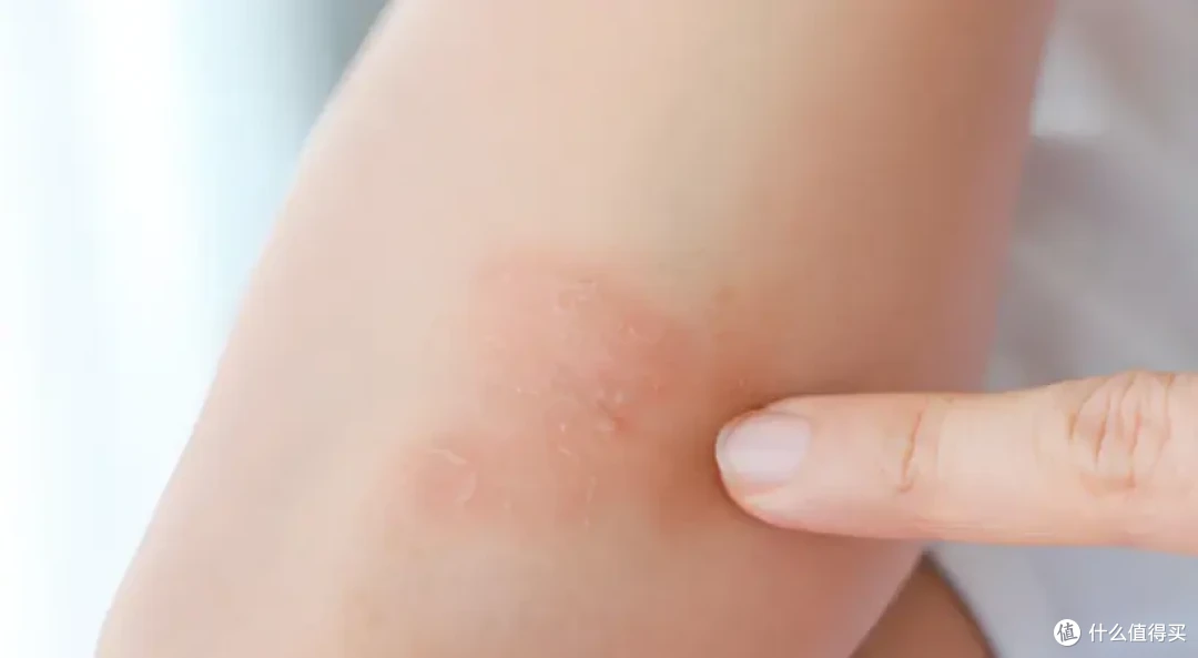 银屑病治疗,正确用药很重要