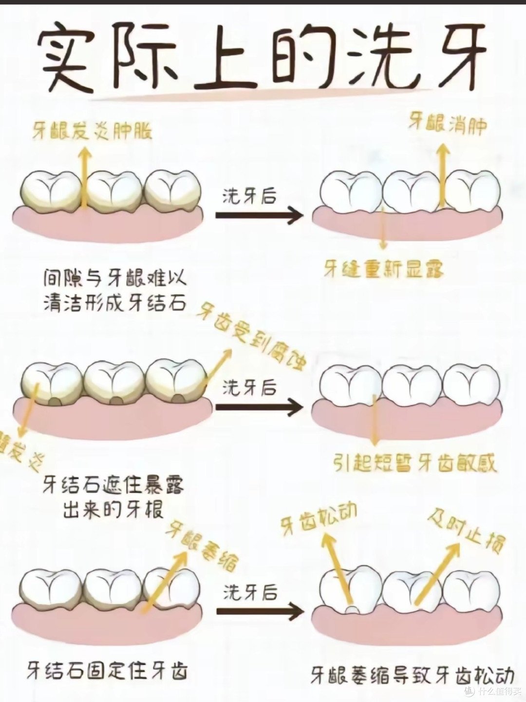 别再纠结!洗过5次牙才懂,定期洗牙真不是智商税