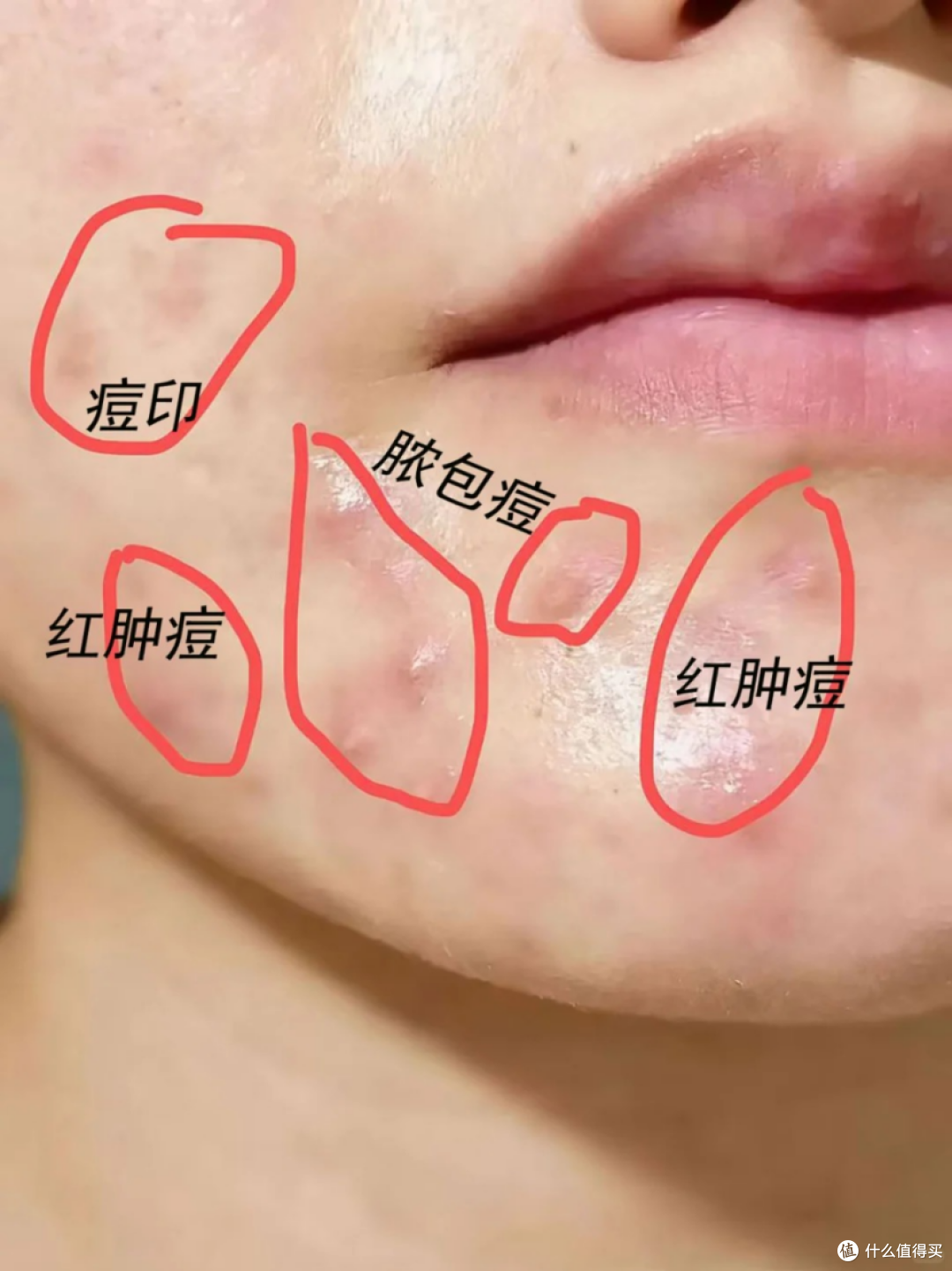 谁懂啊！喝一个月！下巴脸颊终于不冒痘了！