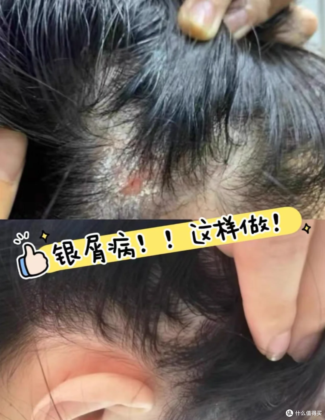 本维莫德乳膏调理头皮银屑病,贵在坚持!