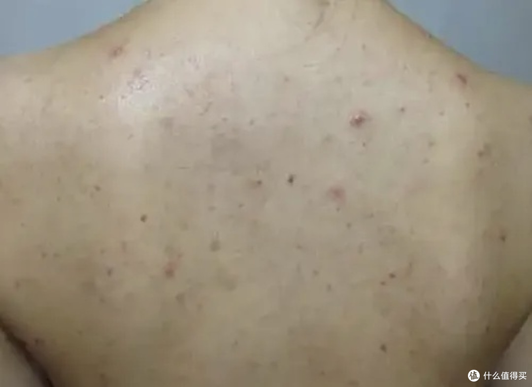 后背痘护肤指南:分清4种类型,精准护理不踩雷