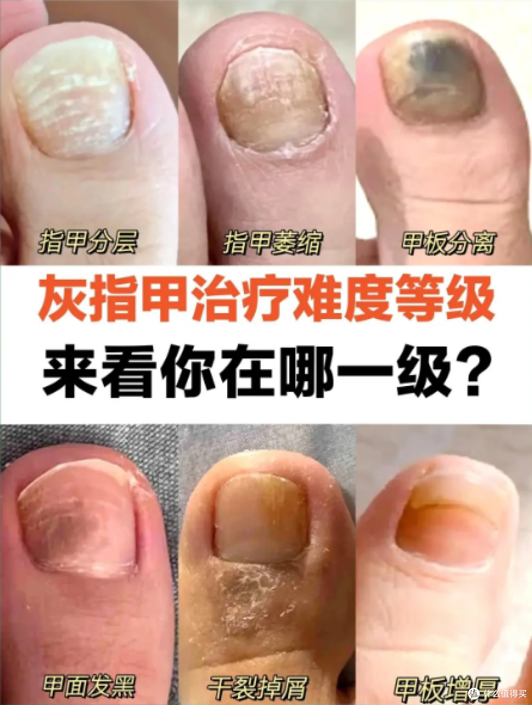 灰指甲不只是老年人了,年轻朋友们也得注意!