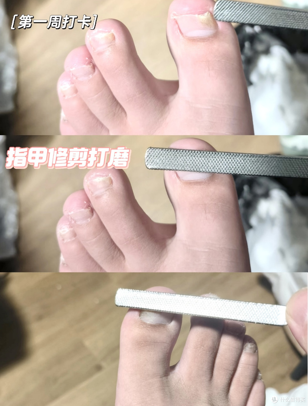 我的灰甲上岸记!脚趾增厚发白,亲测这套方法(纯经验分享)