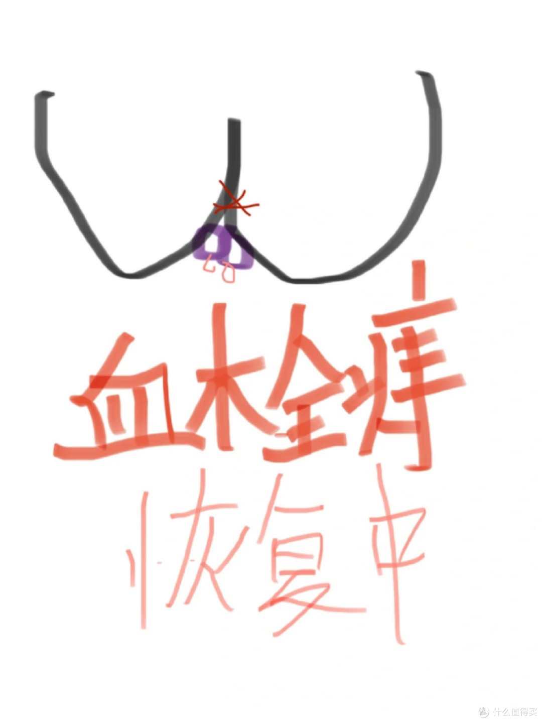产后血栓痔恢复后续,鸽子蛋缩小了!