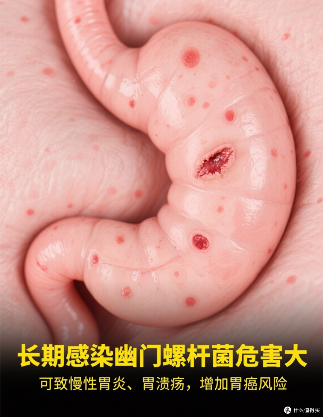 藏在胃里的“隐形杀手”,你可能已经中招了——幽门螺杆菌