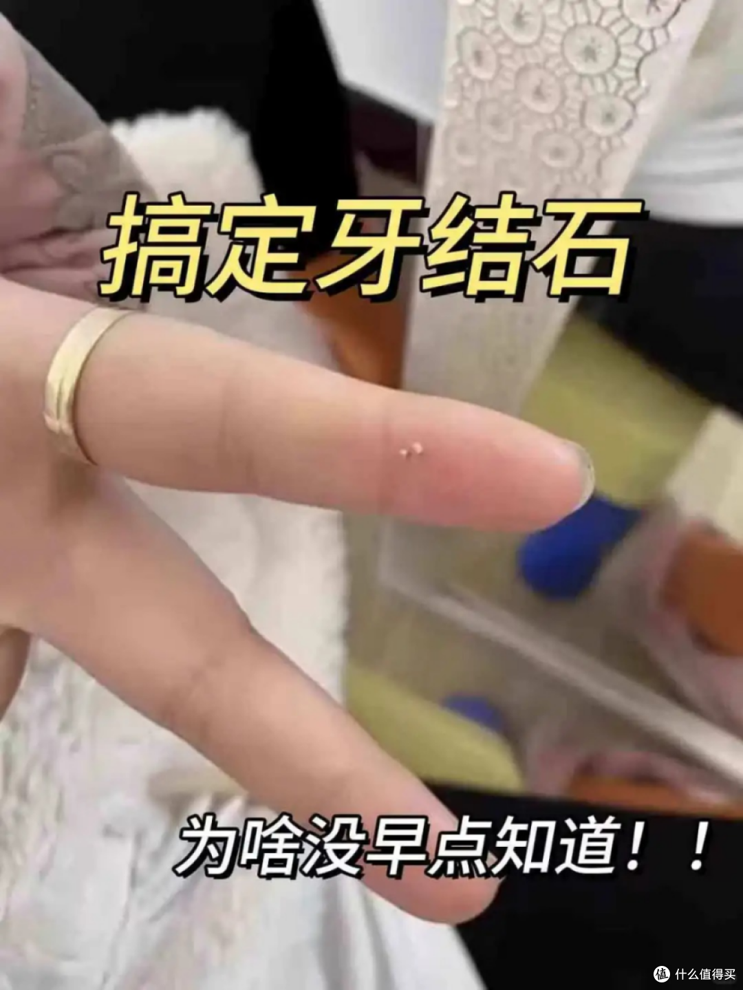 没想到牙结石这么容易就被搞定了，后悔没早点知道