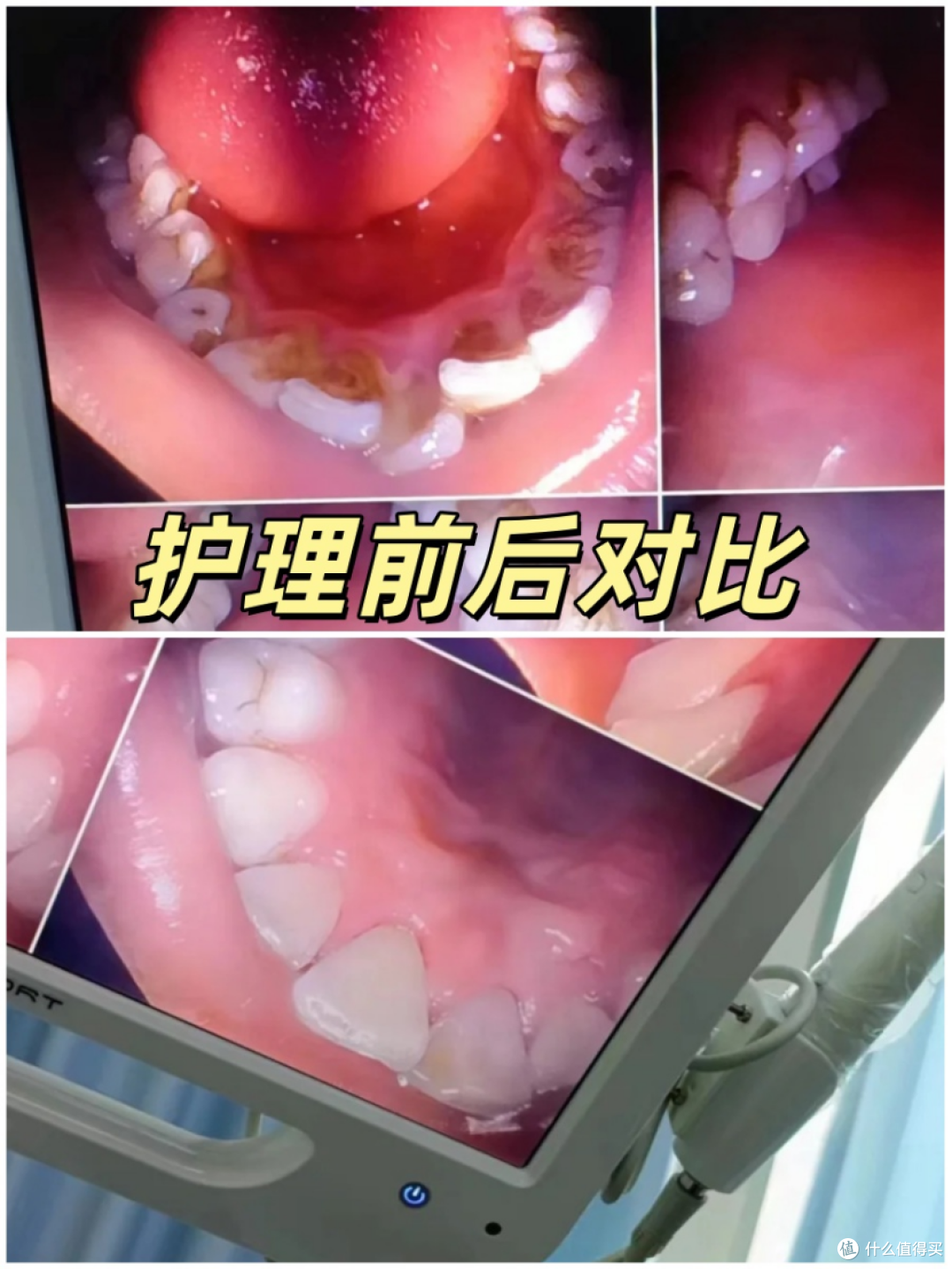 没想到牙结石这么容易就被搞定了，后悔没早点知道