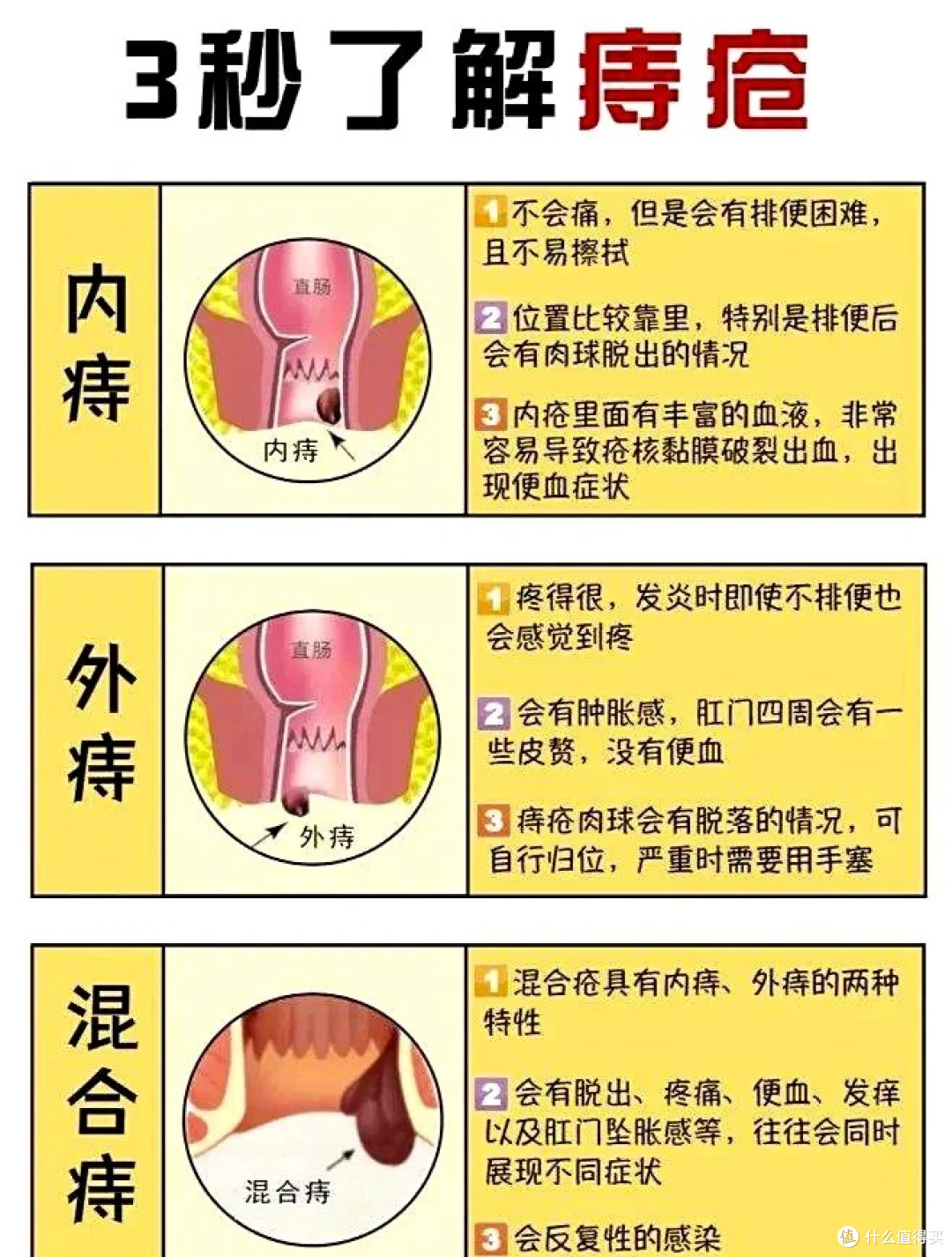 内痔、外痔、混合痔有什么区别?这些“痔疮雷区”千万别踩!