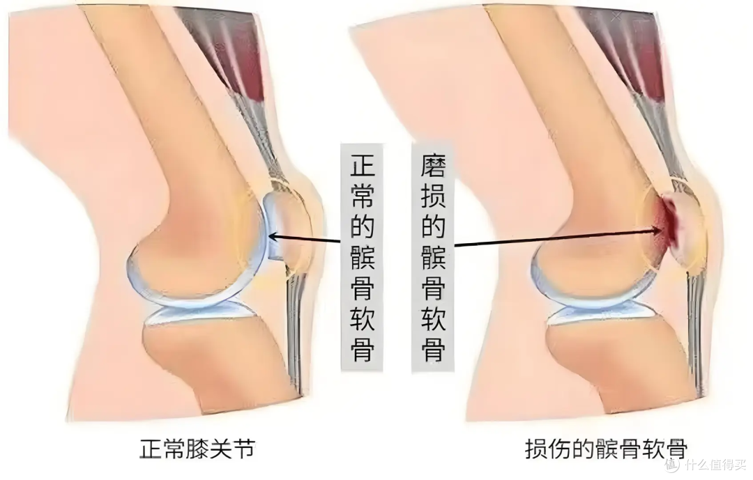 膝盖疼?90% 的人都忽略这 6 个原因,第 4 个年轻人最易中招