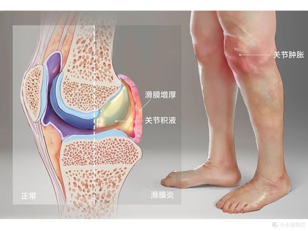 膝盖疼?90% 的人都忽略这 6 个原因,第 4 个年轻人最易中招