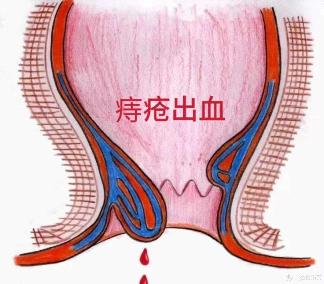 大便后痔疮流血，有哪些应对办法和注意事项？